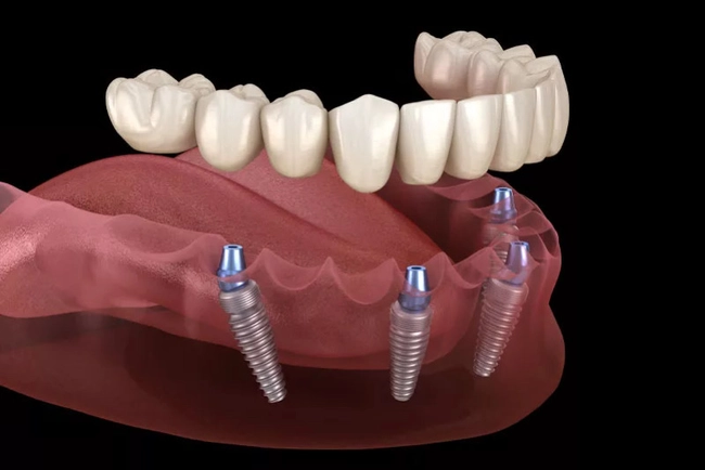 повна імплантація зубів, методика «Все на 4»